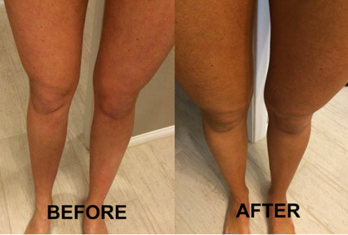 Before and after comparison of legs on a neutral background