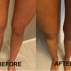 Before and after comparison of legs on a neutral background