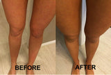 Before and after comparison of legs on a neutral background